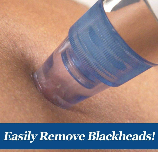 Pore Vacuum Cleaner — Blackhead Remover with Suction