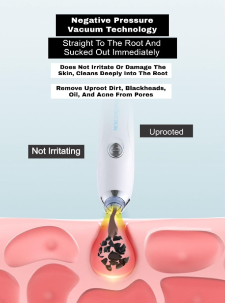 Pore Vacuum Cleaner — Blackhead Remover with Suction